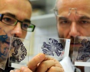 Альцгеймера