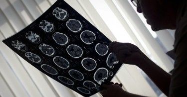 мозг медицина томография